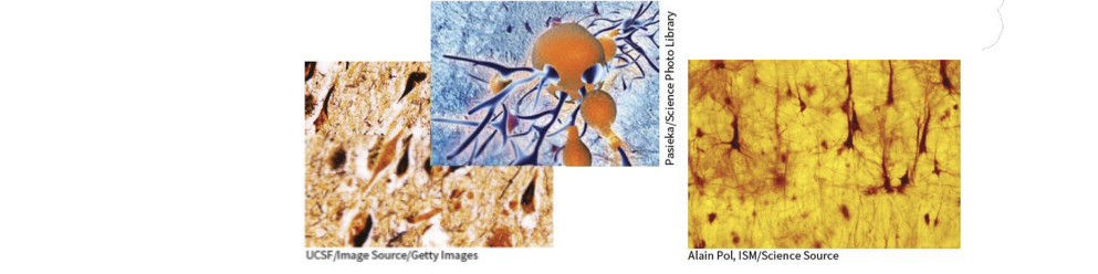 <p>Both senile plaques (protein fragments that accumulate between neurons) and neurofibrillary tangles (insoluble fibres that twist together) are thought to damage neurons in the brains of Alzheimer’s patients (both shown on the left). Plaques and tangles are absent in the healthy brain (right).</p>