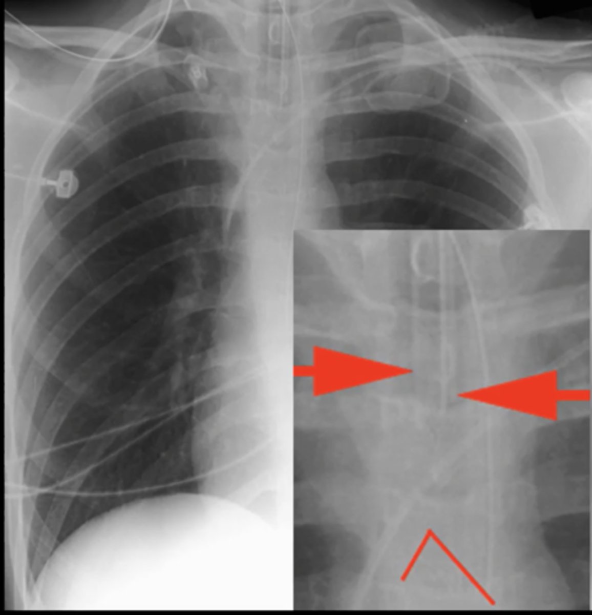 <p>tube that goes down the middle of the spinous processes (down trachea) and should not go past the bifurcation of the trachea</p>