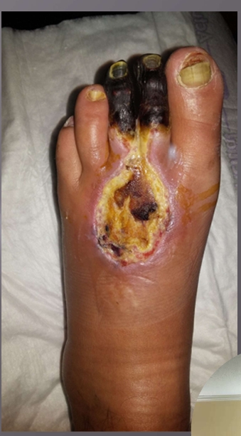 <p>Arteral Ulcers </p>