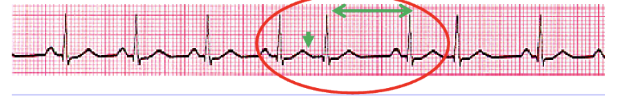 <p>In the premature junctional complex, the premature P wave may occur __ or __ the QRS complex.  As a result, there is a longer __ before the next beat. </p>