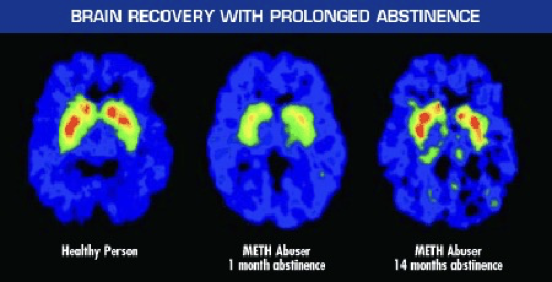 <ul><li><p><span style="background-color: transparent;"><span>When they become abstinent for a month, they still don’t show any of those red peaks. Their brain reward center not firing like a normal person’s would</span></span></p></li><li><p><span style="background-color: transparent;"><span>It can take up to over a year you can see in right panel. Long time before brain can perceive other types of event inside the body or external events being around other people to have that sense of meaning and pleasure</span></span></p></li></ul><p></p>