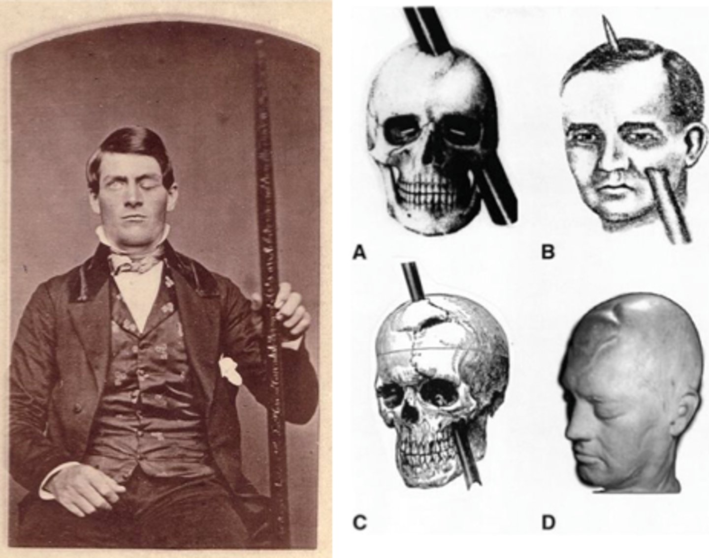 <p>railroad worker who survived a severe brain injury that dramatically changed his personality</p><p>- helped show a connection between brain areas and cognition, frontal lobes and personality/behavior</p>