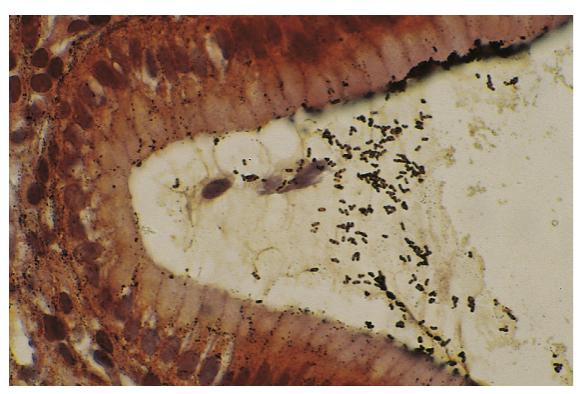 <p>22 A 59-year-old man has had nausea and vomiting for</p><p>5 months. He has experienced no hematemesis. On physical</p><p>examination, there is no abdominal tenderness, and bowel</p><p>sounds are present. Upper gastrointestinal endoscopy shows</p><p>erythematous areas of mucosa with thickening of the rugal</p><p>folds in the gastric antrum. The microscopic appearance of a</p><p>gastric biopsy specimen with a Steiner silver stain is shown</p><p>in the figure. Which of the following factors is most likely</p><p>responsible for this gastric mucosal pathology?</p><p>A Cysteine proteinase</p><p>B Cytotoxin-associated gene A</p><p>C Heat-stable enterotoxin</p><p>D Shiga toxin</p><p>E Verocytotoxin</p>