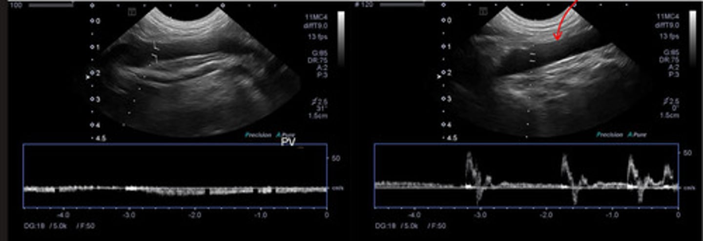 <p>ID vessel indicated by red arrow on a pulsed wave doppler</p>