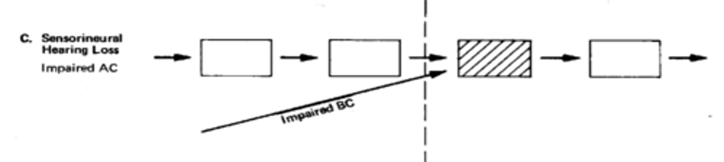 <p>- inner ear is affected by (BOTH AC/BC IMPAIRED).</p><p>- BC bypasses OE/ME.</p><p>- cause of possible lesion could be meinere's.</p>