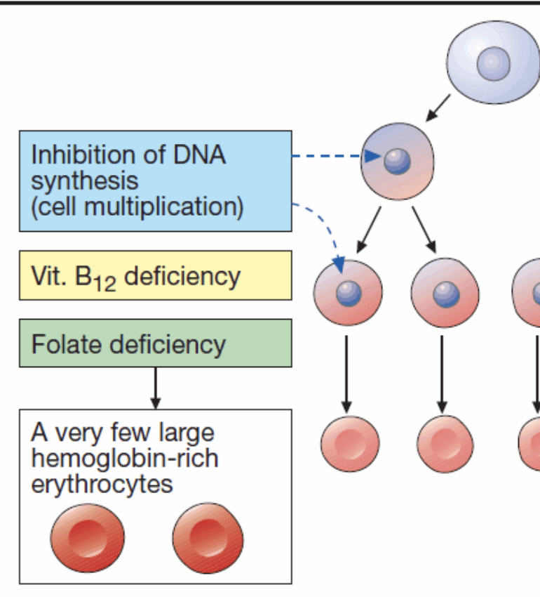 <p>macrocytic anemia</p><ul><li><p>B12 and folate needed to promote DNA synthesis and cell division, therefore low levels → inhibition of DNA synthesis (cell. multiplication)</p></li><li><p>very few, large hemoglobin rich RBCs</p></li></ul><p></p>