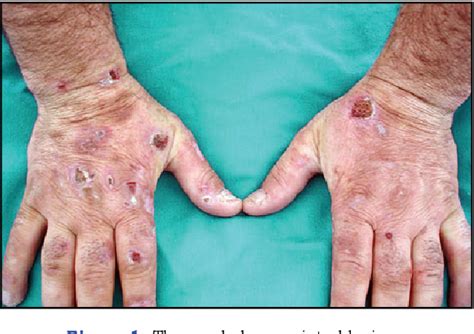 <p>47 yo man, elevated liver enzymes, fatigue</p><p>small vesicles &amp; erosion on both hands. prior lesions healed w/ scarring &amp; hyperpigmentation</p>