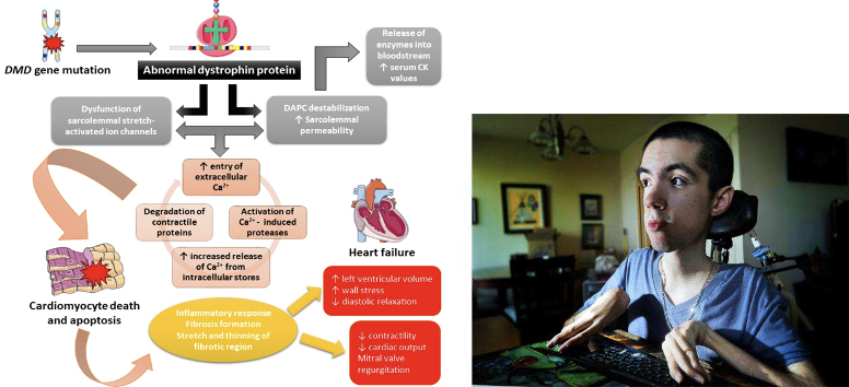 <p>Condition causing muscles to deteriorate because of a defective protein</p><ul><li><p>DMD gene is mutated over time that causes muscles to break down leading to heart failure and death around 15 years old</p></li></ul><p></p>