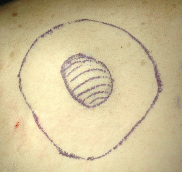 <p>-second surgery (excise scar with same margins)</p><p>-radiation therapy</p><p>-active surveillance</p><p>-metronomic chemo or electrochemo (only done if high grade)</p>