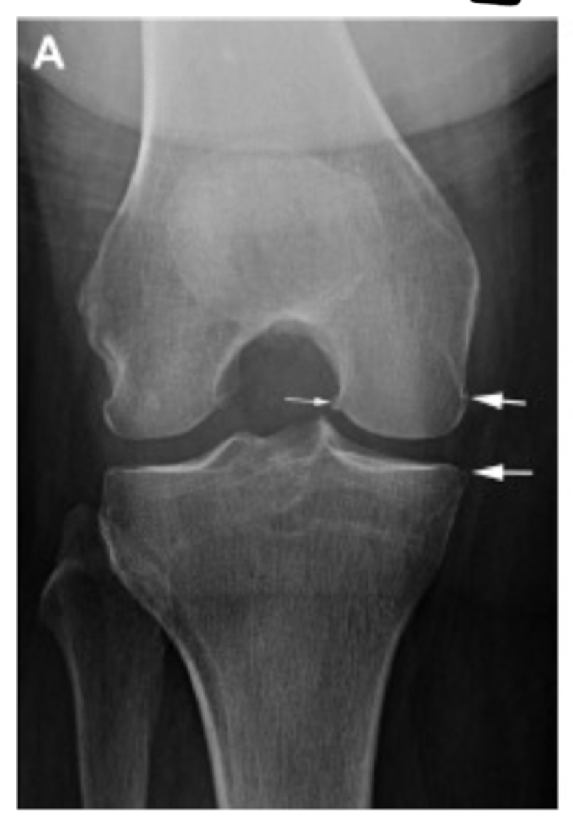 <p>Define the Kelgren Lawrence grade. How do you know?</p>