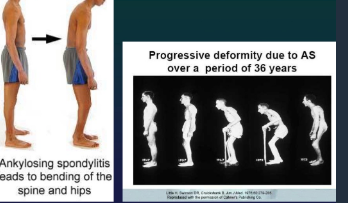 <p>Inflammatory arthropathy & enthesopathy located mainly in the axial skeleton</p><p>HLA-B27</p><p> </p><p>Incidence: 0,1 % pop (15-30 y) - B:F = 2,5-5 : 1</p><p> </p><p>CLINIC</p><ul><li><p>Persistent, progressive</p></li><li><p>Nocturnal</p></li><li><p>Bilat</p></li><li><p>Sensitivity on local pressure</p></li><li><p>LATE: wolf neck, skier position and stepping </p></li></ul><p> </p><p>OBJECTIVE SIGNS</p><ul><li><p>Occipital : wall dist</p></li><li><p>Finger : ground dist</p></li><li><p>Schober Test</p></li><li><p>Ches expansion</p></li></ul><p></p>