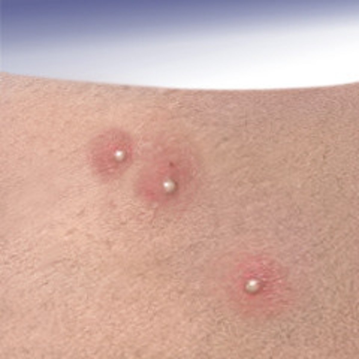 <p>vesicles that contain pus. They are elevated, usually yellow-topped lesions that contain pus</p>