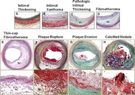 <p>What features characterise Late-stage Fibroatheroma?</p>