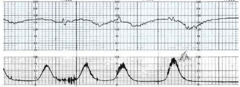 <p>The nurse is monitoring a patient in labor and notes this fetal heart rate pattern on the electronic fetal monitoring strip (see figure). Which is the most appropriate nursing action? </p><p>a. Administer oxygen with a face mask at 8 to 10 L/minute. </p><p>b. Reposition the fetal monitor ultrasound transducer. </p><p>c. Assist the patient to the bathroom to empty her bladder. </p><p>d. Continue to monitor the patient and fetal heart rate patterns.</p>