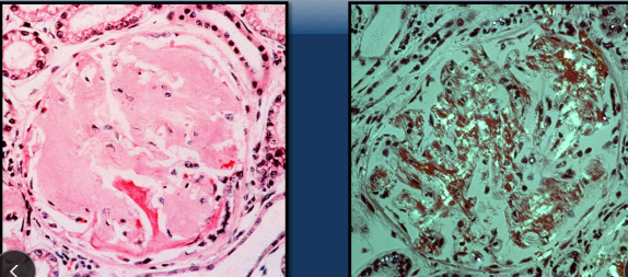 <p><span style="background-color: transparent;"><strong>Amyloidosis</strong></span></p>