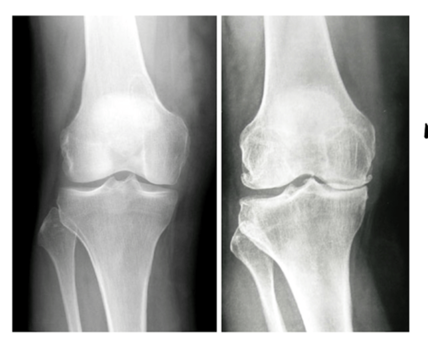 <p>Loss of cartilage (primary indication of OA, along with bone spurs and sclerosis)</p>