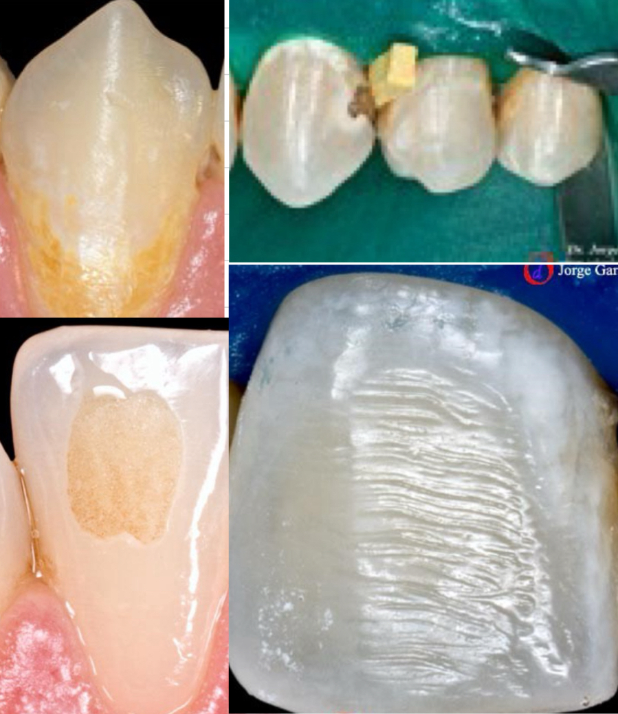 <p>White / yellow spots</p><p>Cavitations</p><p>Bonding material remains</p><p>Effect of the bur on the enamel when removing brackets</p>