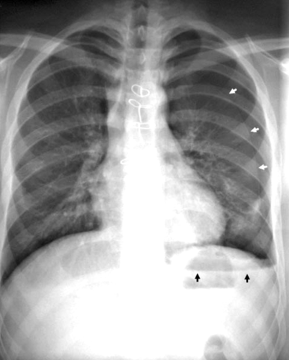 <p>2 key findings in this x-ray and dx</p>