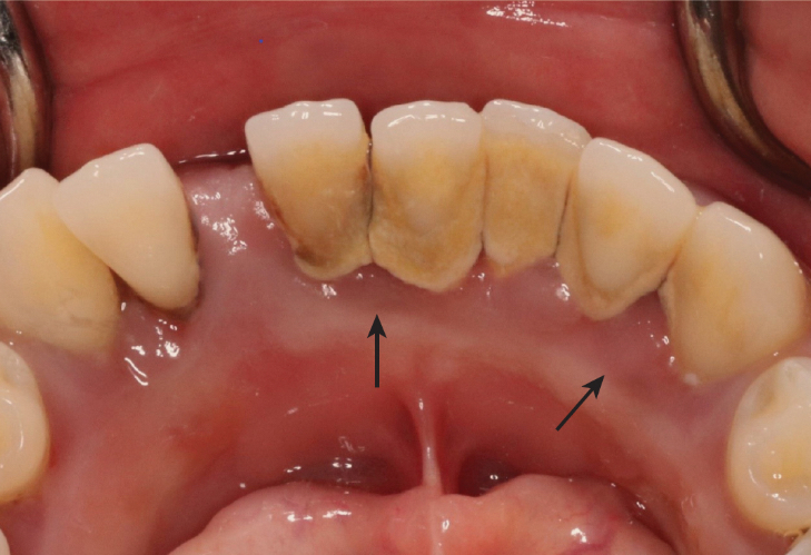 <p>reddish-blue color of gingivitis</p><p>blood flow increases → blood vessels become congested → slows flow of oxygenated blood to tissues and the flow of unoxygenated blood away from the tissues → unoxygenated blood pools in the gingival tissues</p>