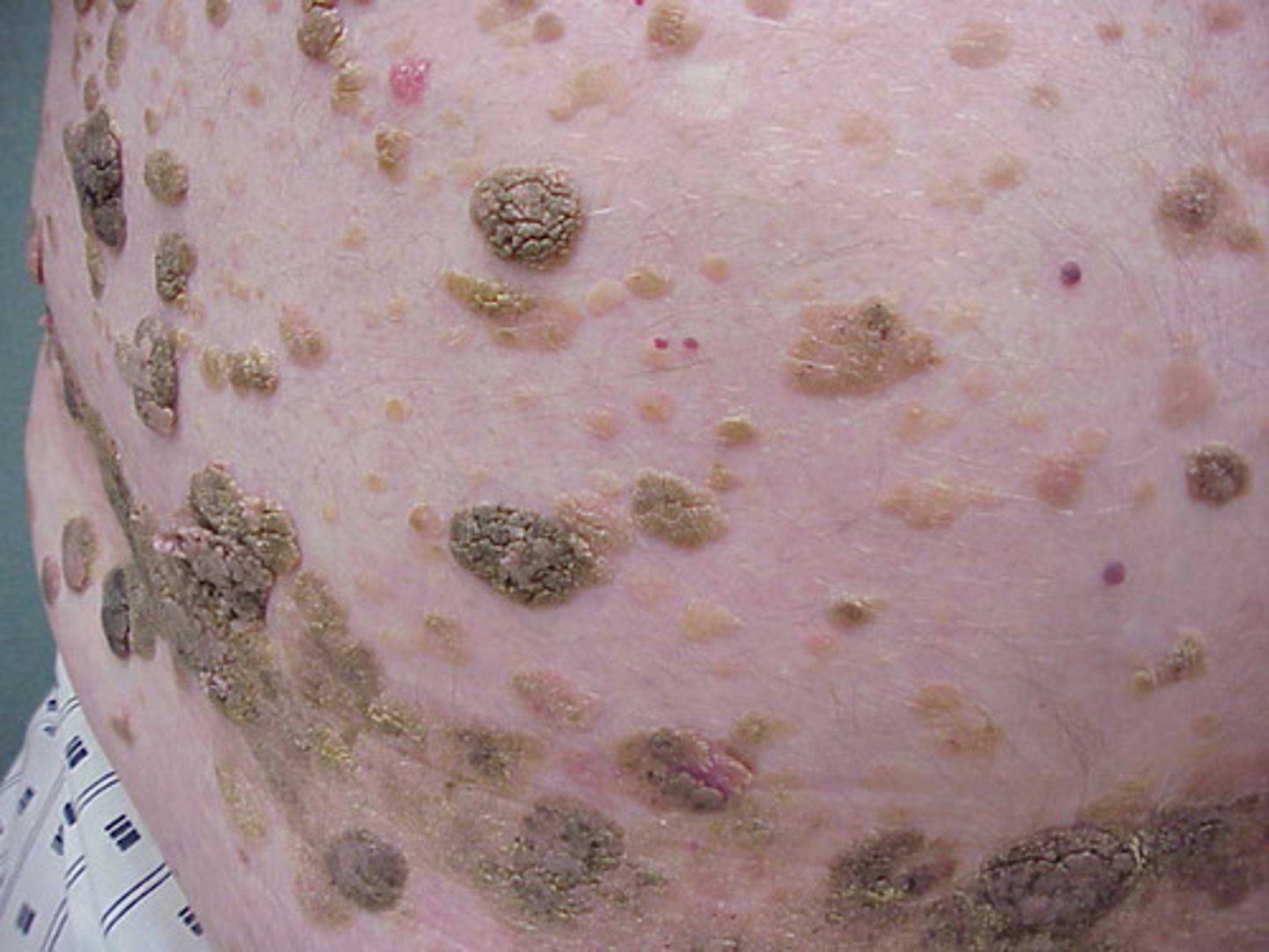 <p>which type of pigmented lesion:</p><p>• Extremely common lesion in</p><p>older patients</p><p>• Unknown cause</p><p>• Does not occur in the mouth</p><p>• Brown-tan macules that over</p><p>time become sharply</p><p>demarcated plaques</p><p>• Can be rough, fissured,</p><p>verrucous</p><p>• "Stuck on" appearance</p>