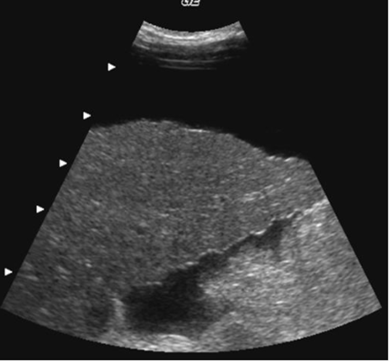 <p>In the image below, the surface nodularity of the liver is indicative of:</p><p>a. cirrhosis</p><p>b. metastatic disease</p><p>c. hepatitis</p><p>d. fatty infiltration</p><p>e. hydatid disease</p>