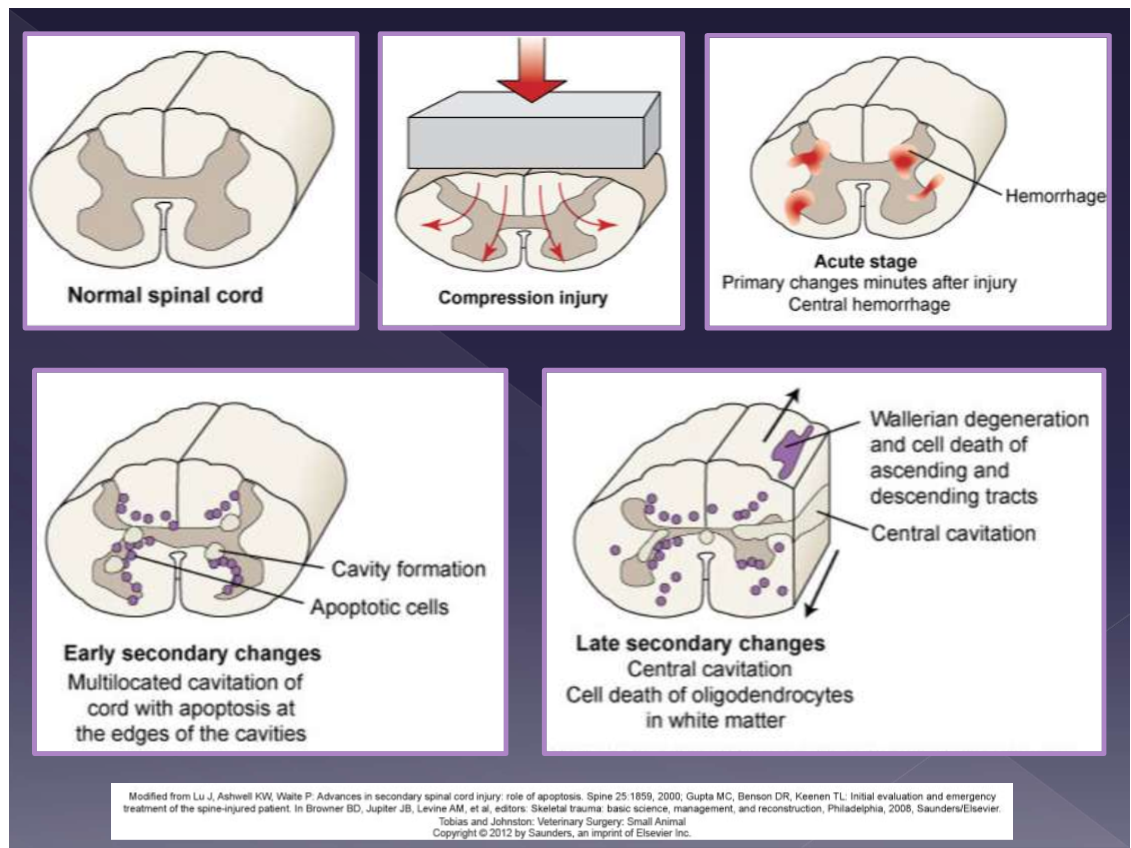 <ul><li><p>contusion </p><ul><li><p>spinal instability </p><ul><li><p>fracture </p></li><li><p>luxation </p></li></ul></li><li><p>disc herniation </p></li><li><p>blunt trauma </p></li></ul></li><li><p>compression </p><ul><li><p>disc herniation </p></li><li><p>disc protrusion </p></li><li><p>spinal instability </p><ul><li><p>fracture </p></li><li><p>luxation </p></li></ul></li><li><p>blunt trauma </p></li><li><p>localized hemorrhage </p></li><li><p>spinal cord > brain </p></li><li><p>primary damage </p><ul><li><p>mechanical trauma </p></li><li><p>axonal injury </p></li><li><p>hemorrhage </p></li><li><p>edema </p></li></ul></li><li><p>secondary biochemical effects </p><ul><li><p>demyelination </p></li><li><p>neuronal and glial cell necrosis </p></li><li><p>inflammatory response - IL, TNF, NO </p></li></ul></li><li><p>severity depends on: </p><ul><li><p>etiology </p></li><li><p>speed of onset </p></li><li><p>duration </p></li><li><p>location </p></li><li><p>amount of compression </p></li></ul></li></ul></li></ul><p></p>