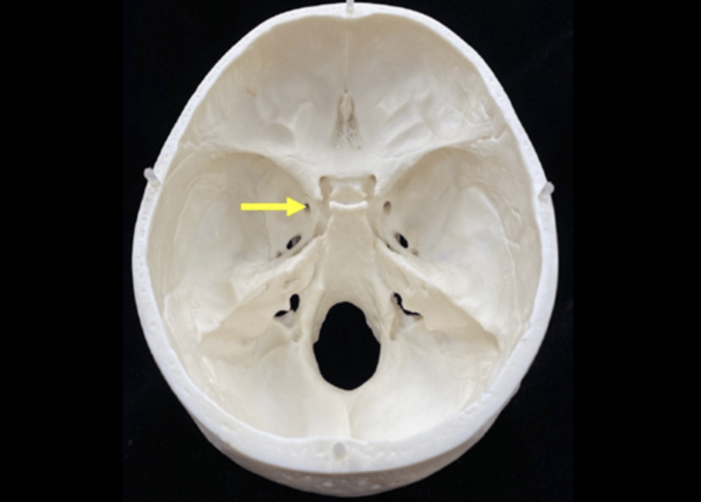 <p>name the bone and bone feature</p>