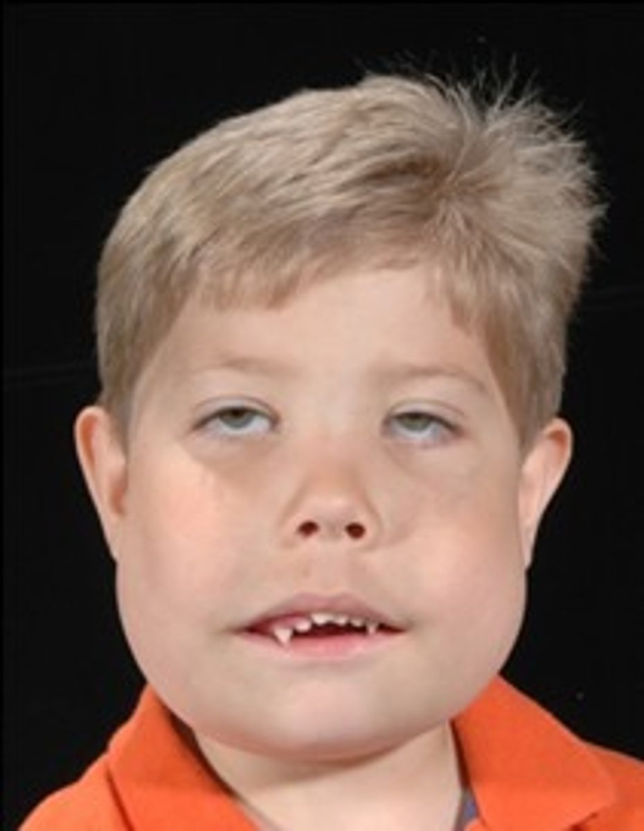 <p>inherited developmental abnormality</p><p>bilateral enlargement of jaws</p>