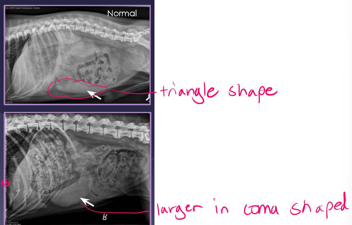 <p>splenic torsion </p>