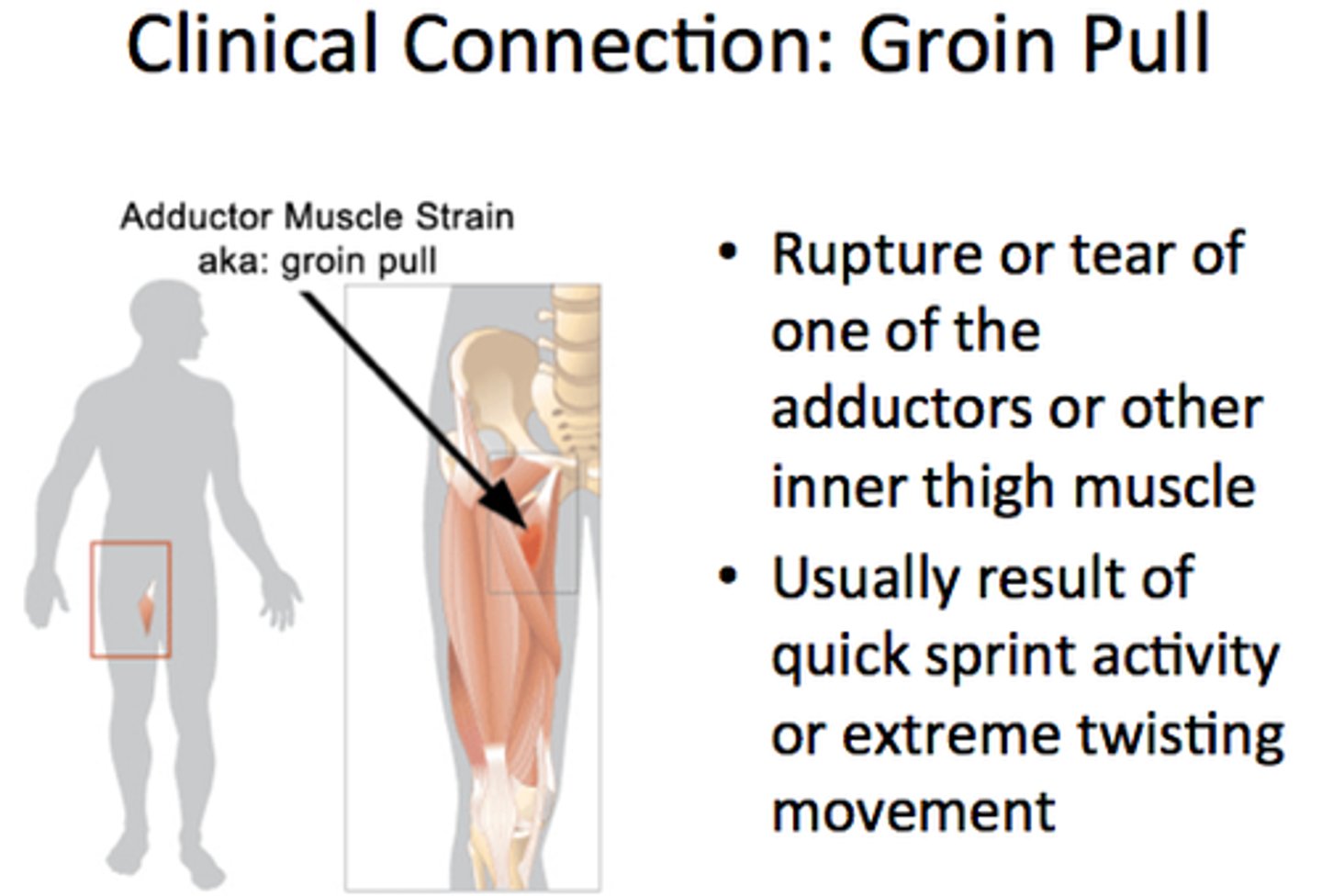 <p>Overstretched or torn thigh adductor muscles</p>