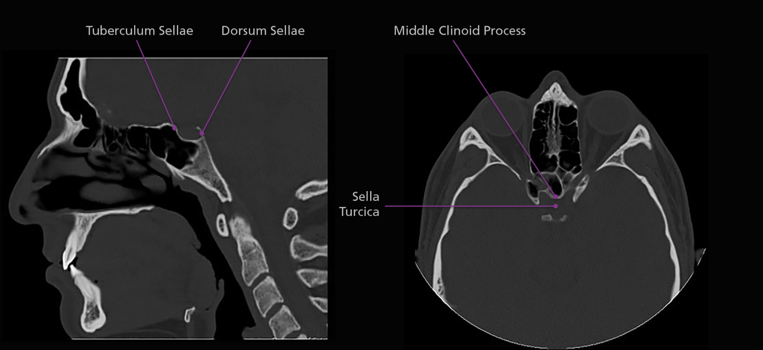 <p>The sella turcica is surrounded by 4 elevations: the tuberculum sellae anteriorly, the middle clinoid processes laterally and the dorsum sellae posteriorly. Arising from the superior border of the dorsum sellae are the posterior clinoid processes. The body of the sphenoid articulates anteriorly with the cribriform plate of the ethmoid bone via a midline crest called the sphenoidal crest.</p>