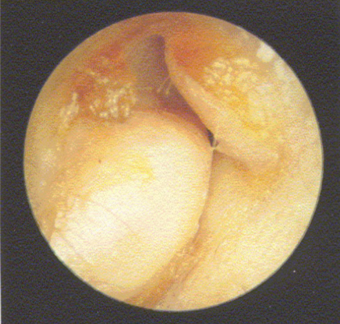 <p><u>disordered otoscopy: canal</u></p><p>osteoma</p>