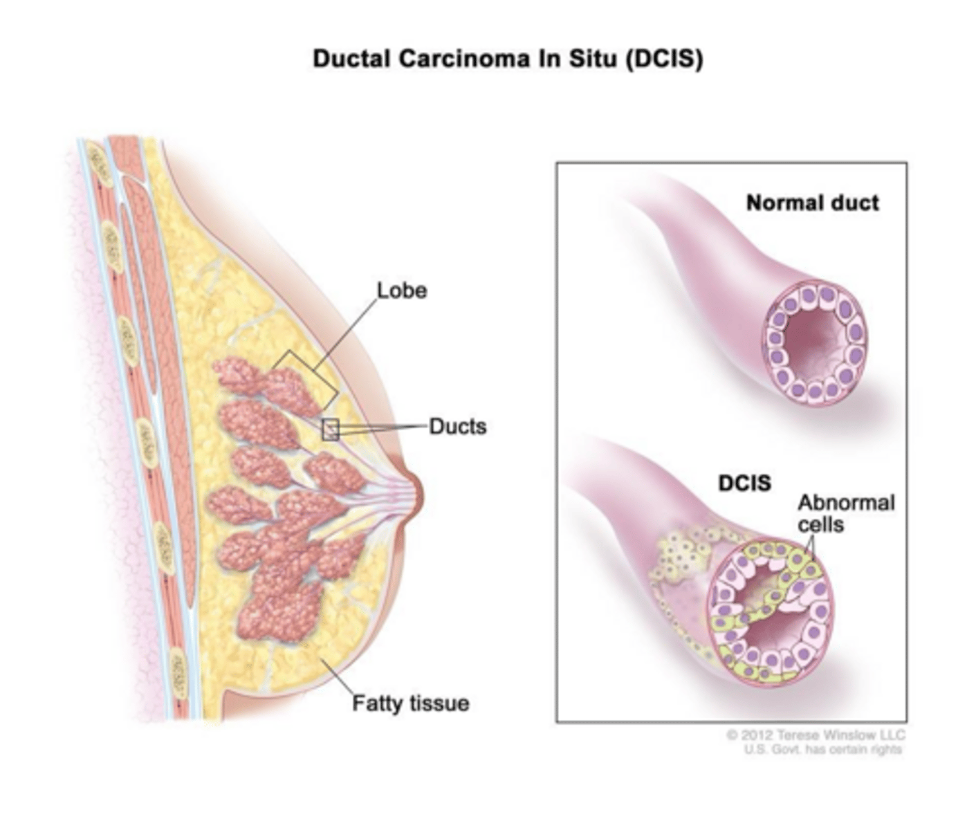 <p>Core biopsy guided by ultrasound.</p>