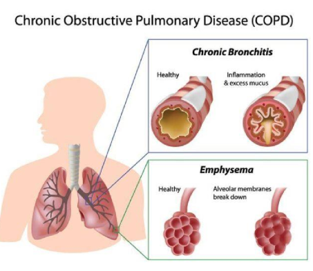 <p>(Chronic Obstructive Pulmonary Disease) is a progressive lung disease that causes breathing difficulties due to airflow obstruction. </p><ul><li><p>most commonyl caused by smoking</p></li></ul><p></p>