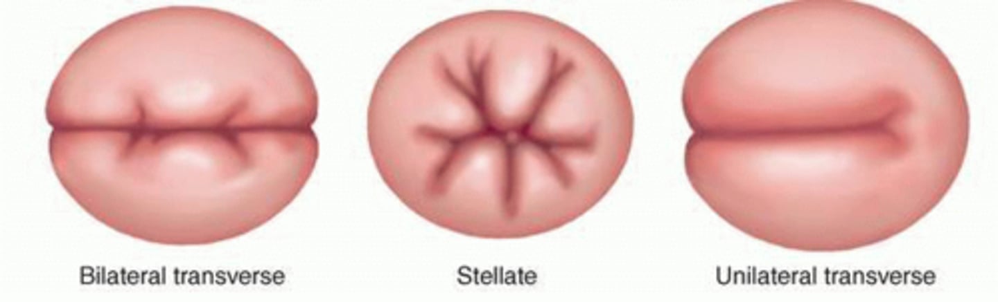 <p>bilateral transverse, stellate, unilateral transverse</p>