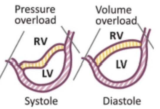 <p>Ventricular interdependence: Septal shift and D shaped LV</p>