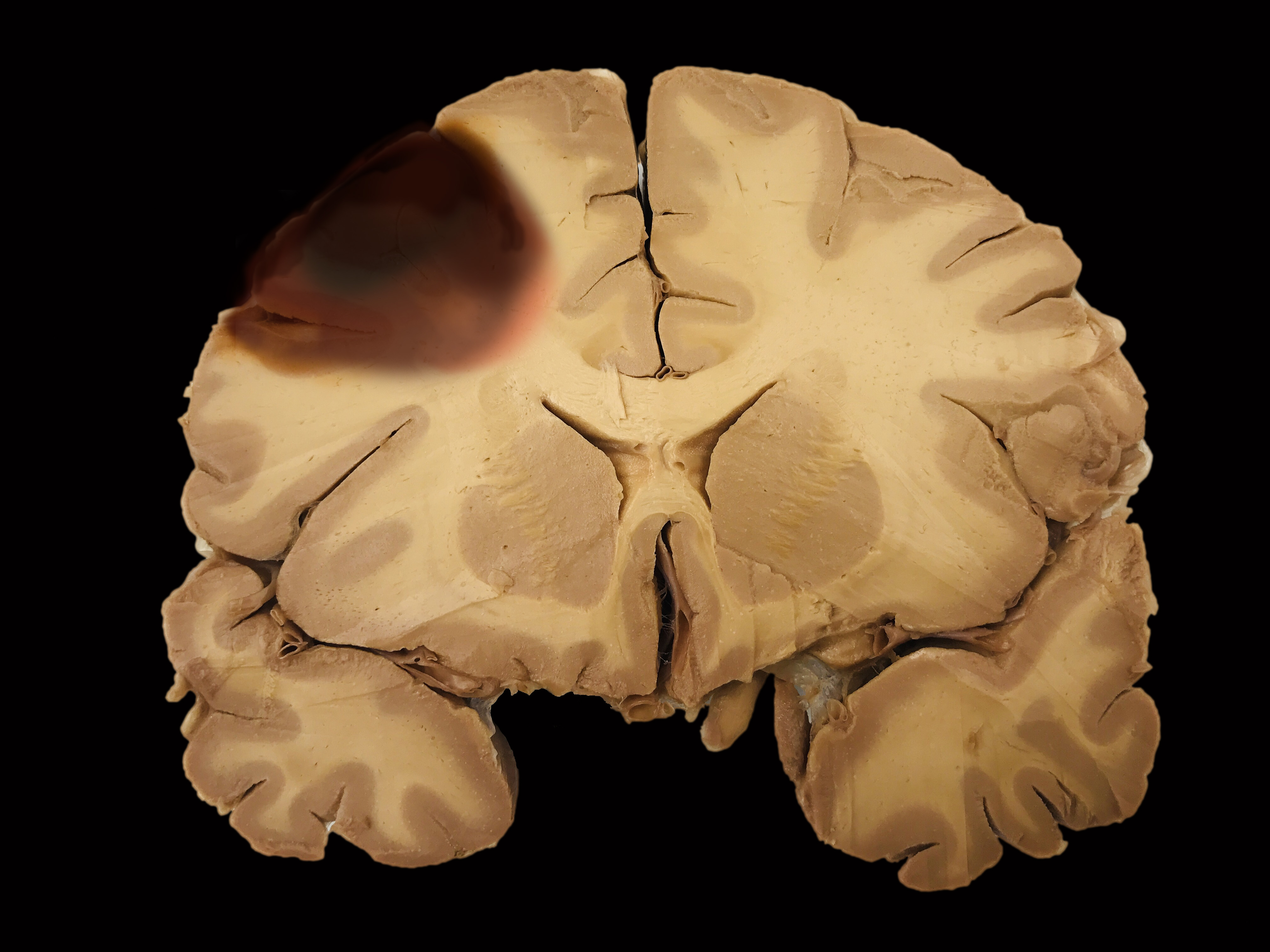 what type of brain does this MRI show