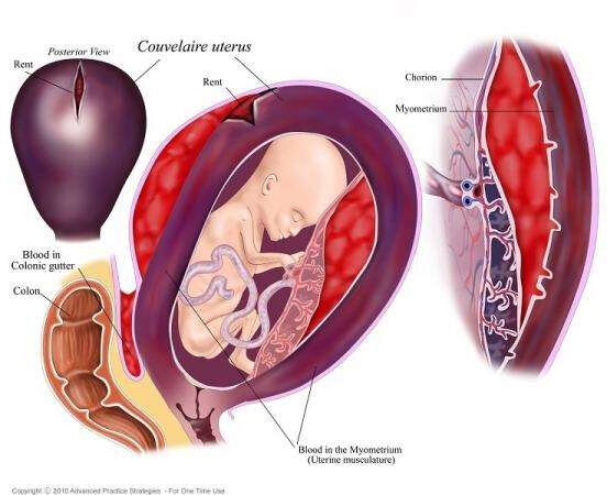 <p>Útero de Couvaliere</p>