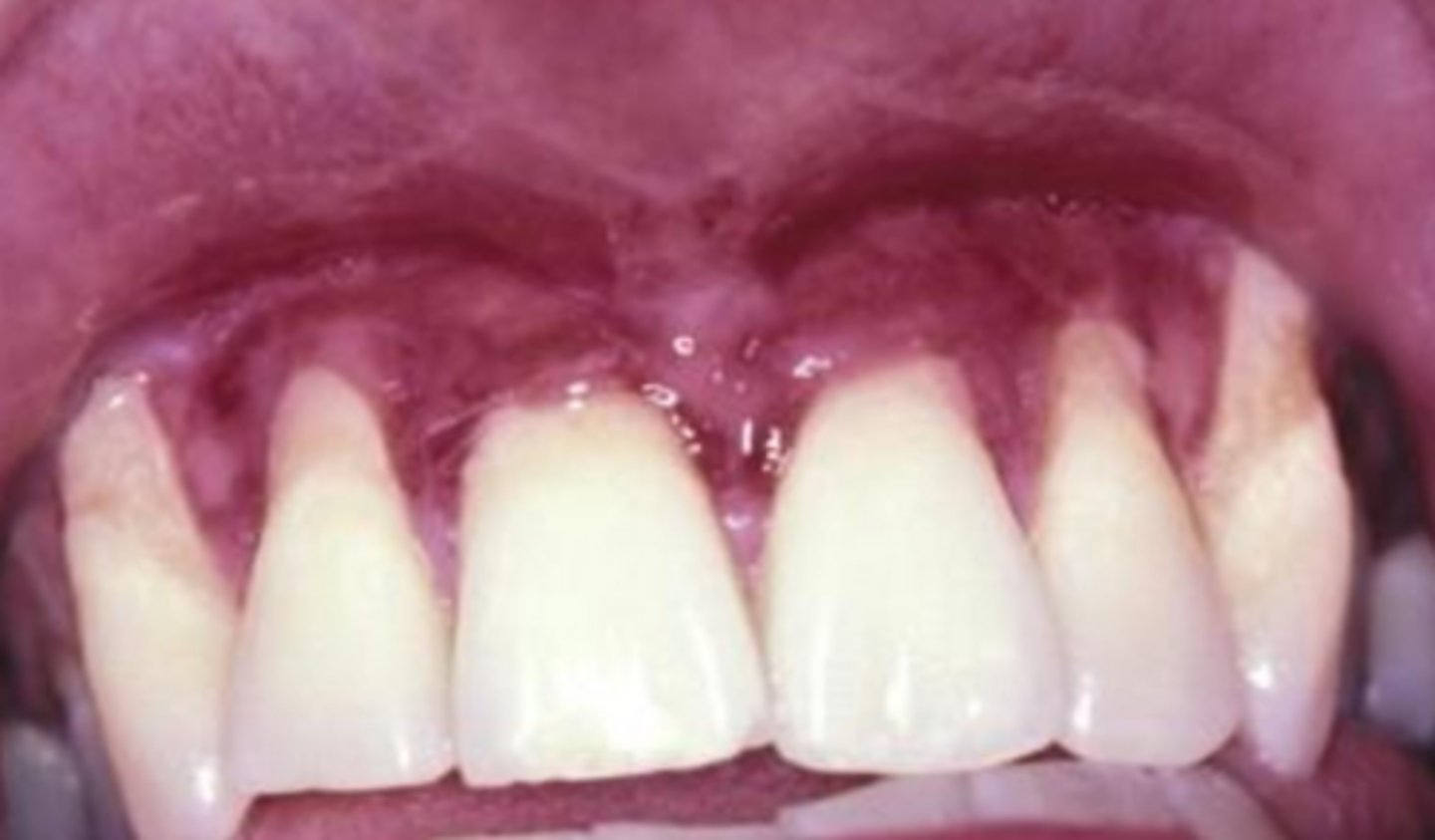 <p>epidermolysis bullosa</p>