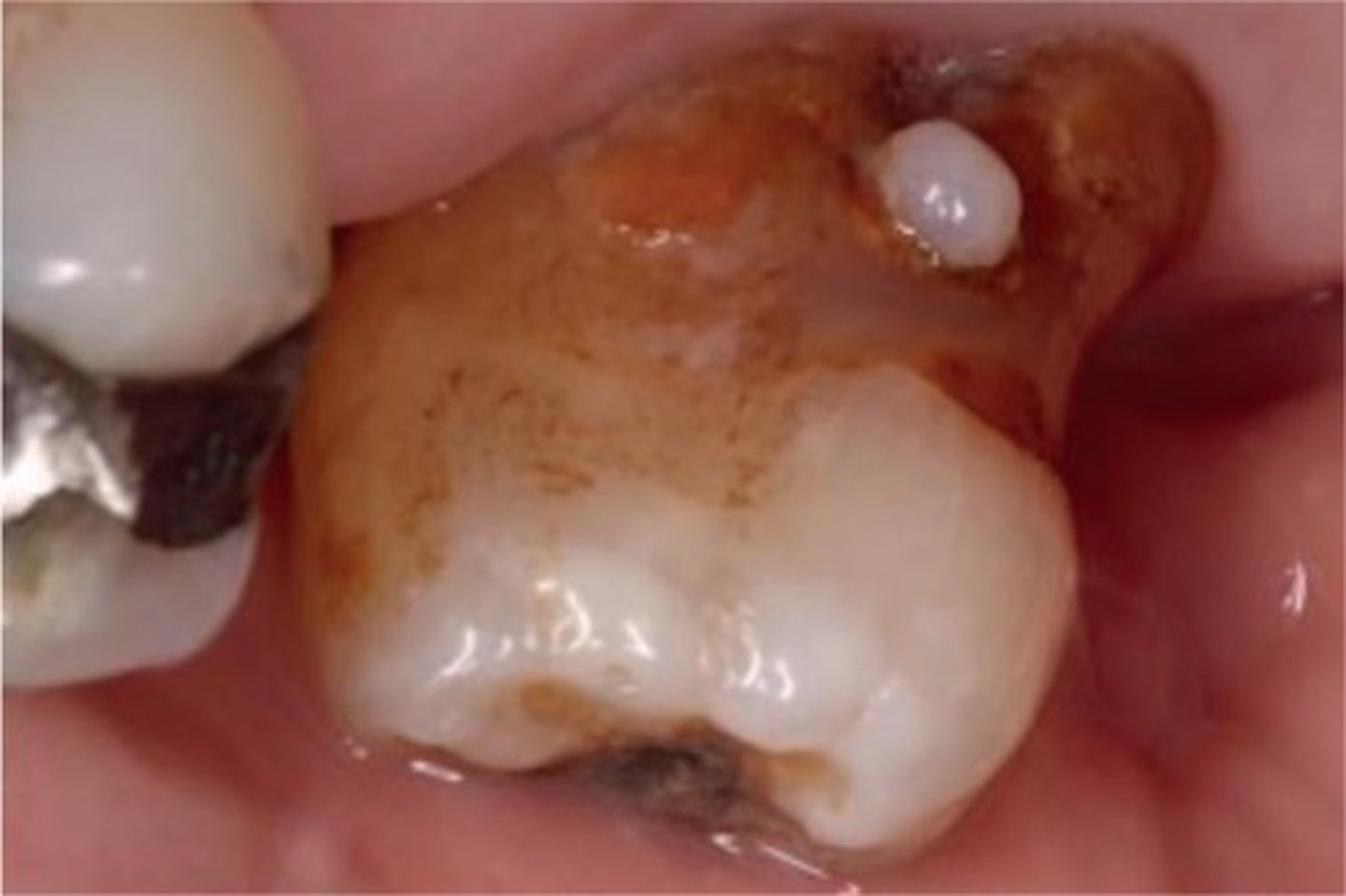 <p>An extreme formation of cementum on the outside of the root, often associated with bone destruction or trauma.</p>