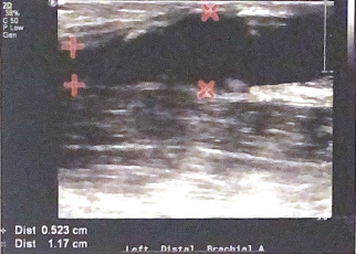 <p>in this image, do the diameters measured support the diagnoses of arterial aneurysm? why or why not?</p>