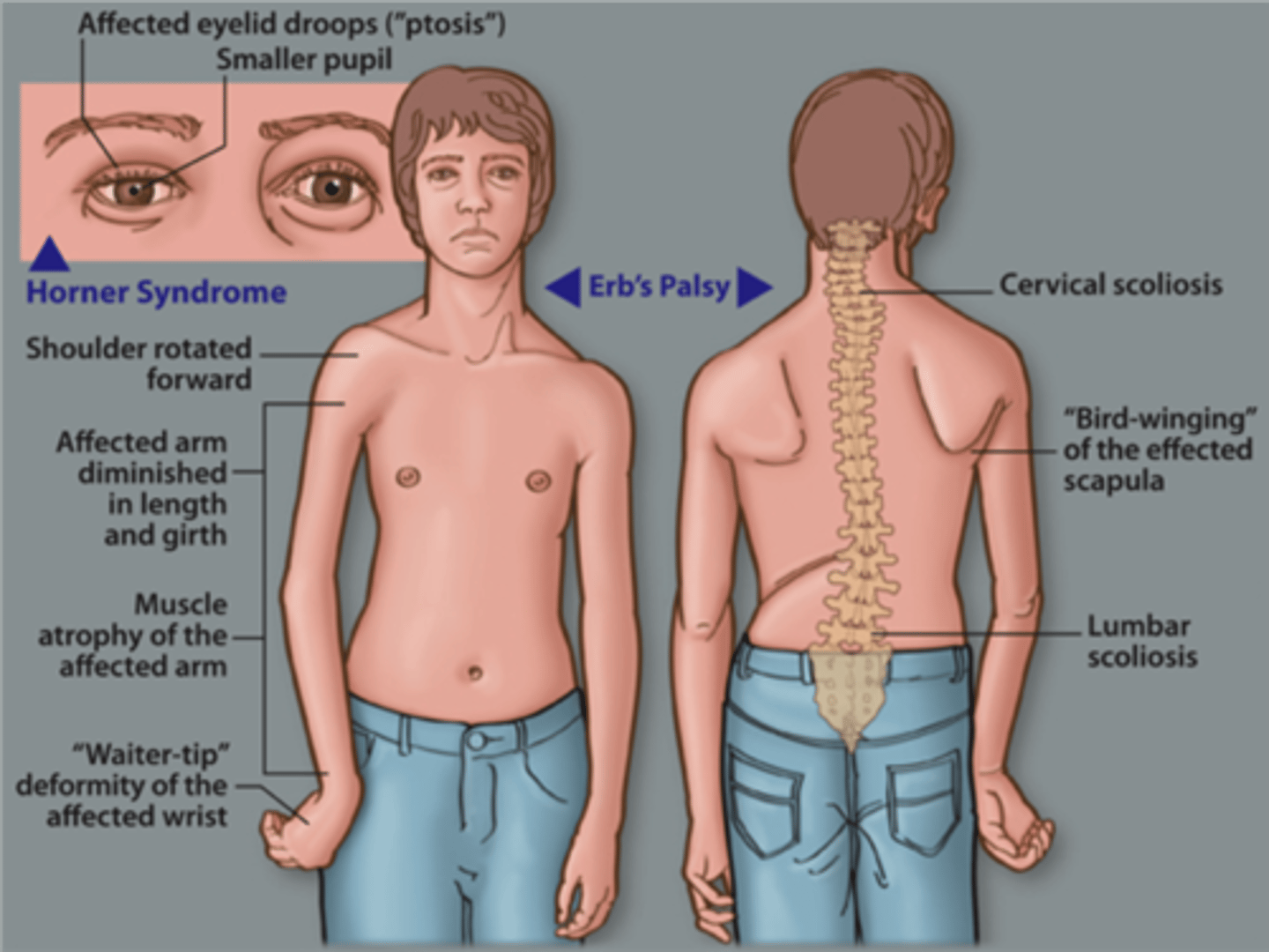 <p>Erb-Duchenne palsy</p><p>(superior trunk [C5-C6] brachial plexus injury: "waiter's tip")</p>
