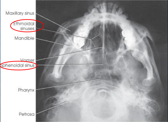 <ul><li><p>demonstrates:</p><ul><li><p>sphenoid and ethmoid sinuses</p></li><li><p>mandible</p></li><li><p>bony nasal septum</p></li></ul></li><li><p>no tilt:</p><ul><li><p>equidistant lateral border of skull to mandibular condyles</p></li></ul></li><li><p>IOML parallel to IR:</p><ul><li><p>superimposition of anterior frontal bone by mental protuberancce</p></li><li><p>insufficient neck extension will cause mandible to superimpose ethomoid sinuses</p></li></ul></li><li><p>mandible condyles anterior to petrous pyramids</p></li><li><p>air-fluid levels, if present</p></li></ul><p></p>