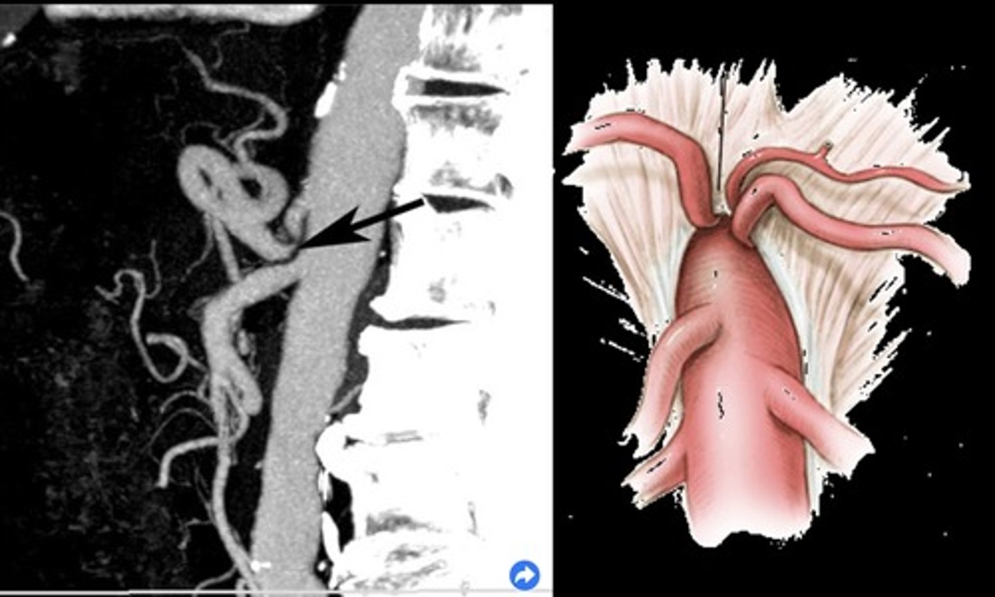 <p>Compression of celiac axis during exhalation by median arcuate ligament</p><p>Pain relieved by inhalation</p><p>Evaluate in supine &amp; upright positions and with inspiration &amp; expiration</p>