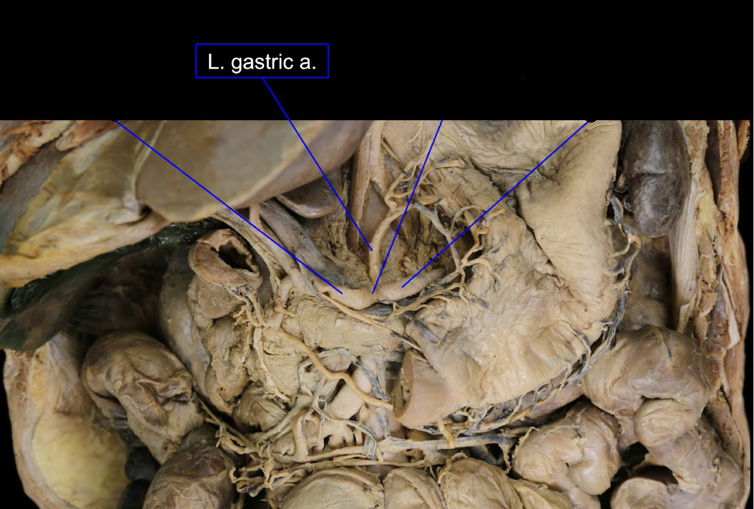 <p>A). left gastric artery<br>B). lesser curvature of the stomach<br>C). celiac trunk of the abdominal aorta</p>