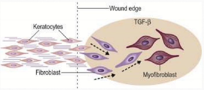 <p>The keratocytes transform into myofibroblasts, which are highly reflective cells that disrupt corneal transparency. </p>