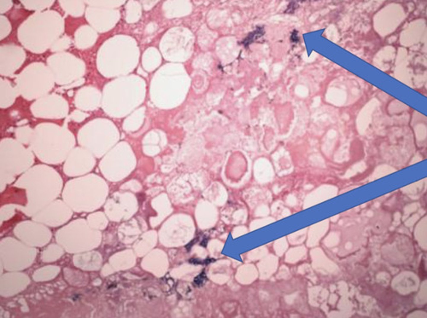<p>What type of calcification is seen here?</p>