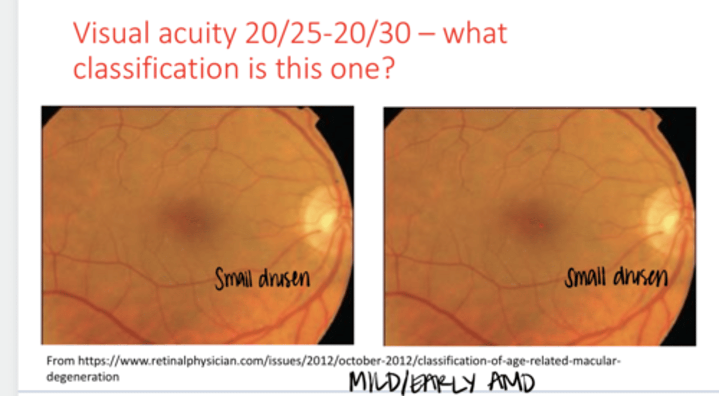 <p>Visual Acuity is 20/25-20/30. What is the classification of this AMD? (See Pic)</p>