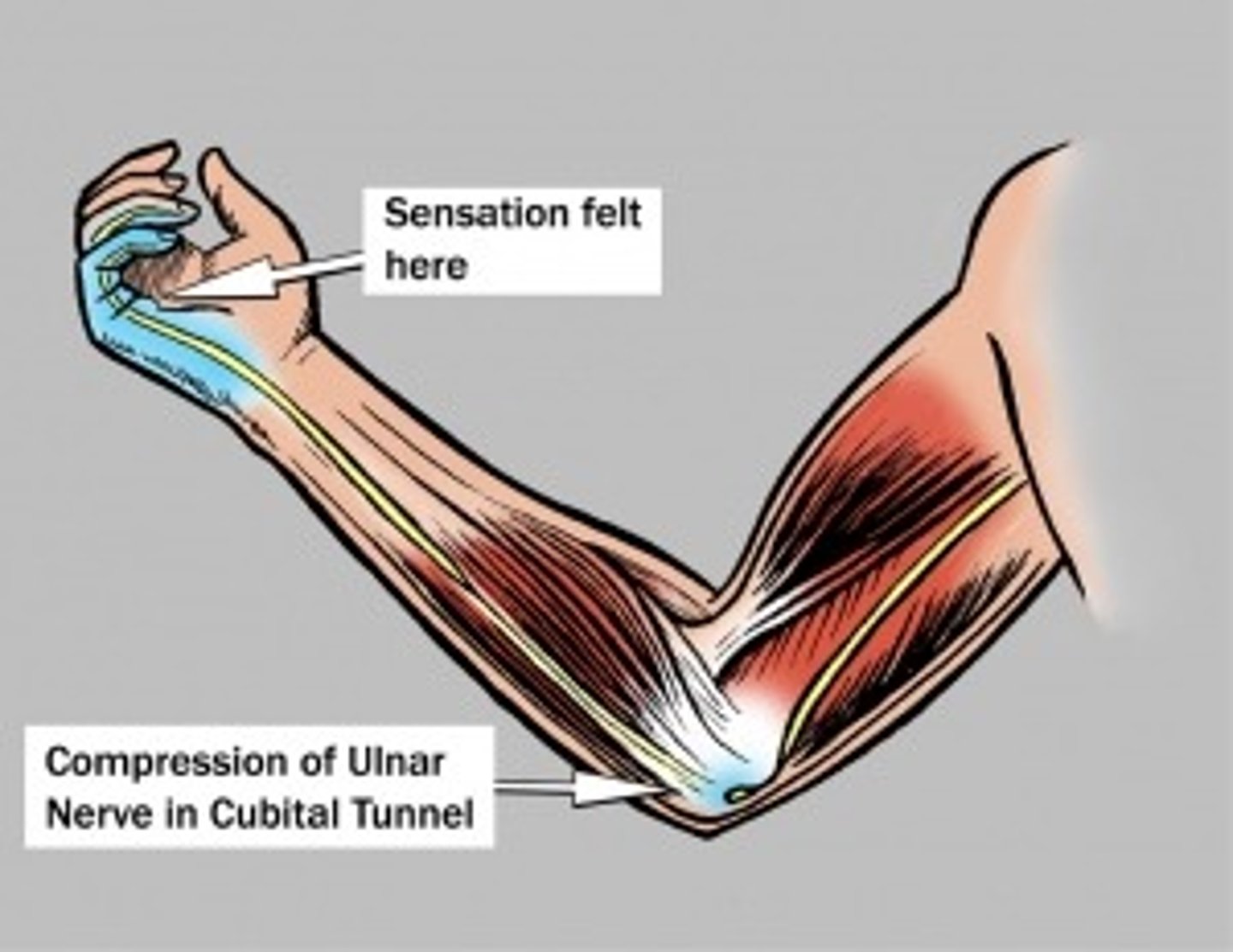 <p>Pain, numbness, tingling along ulnar nerve distribution due to nerve compression</p>