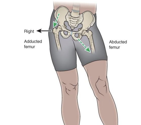 <p>pelvic cannot “hike” </p><p>both hips will move in frontal plane</p><p>if pelvis shifts to the right, right hip joint will be adducted and left hip will be abducted </p>